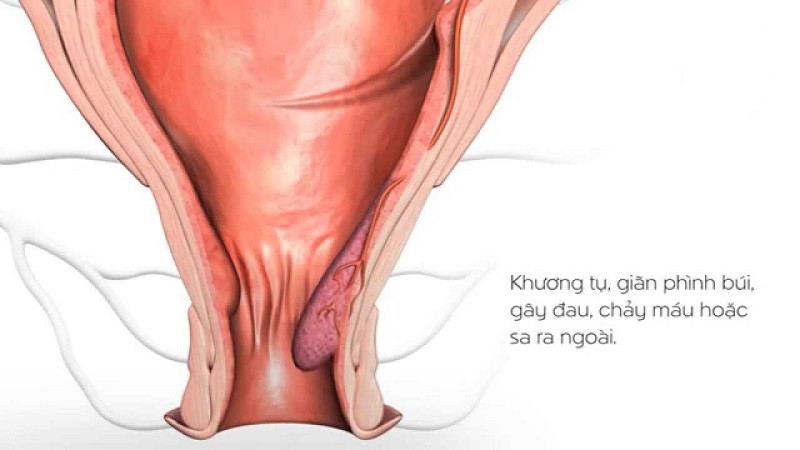 Hoa mào gà đỏ hỗ trợ điều trị trĩ xuất huyết